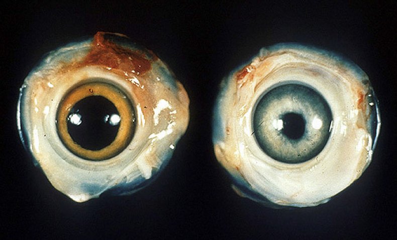 În stânga este un ochi de pui normal. În dreapta - ochiul unui pui bolnav cu boala lui Marek