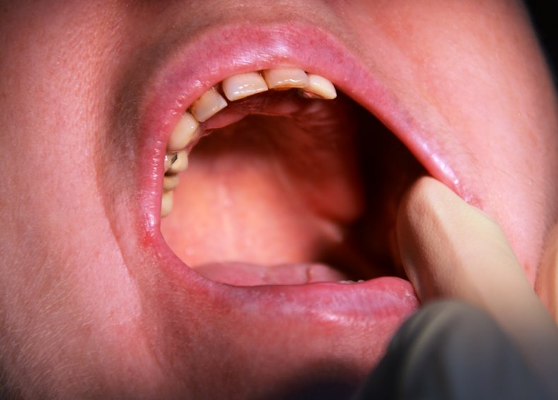 Inflamația în cavitatea bucală