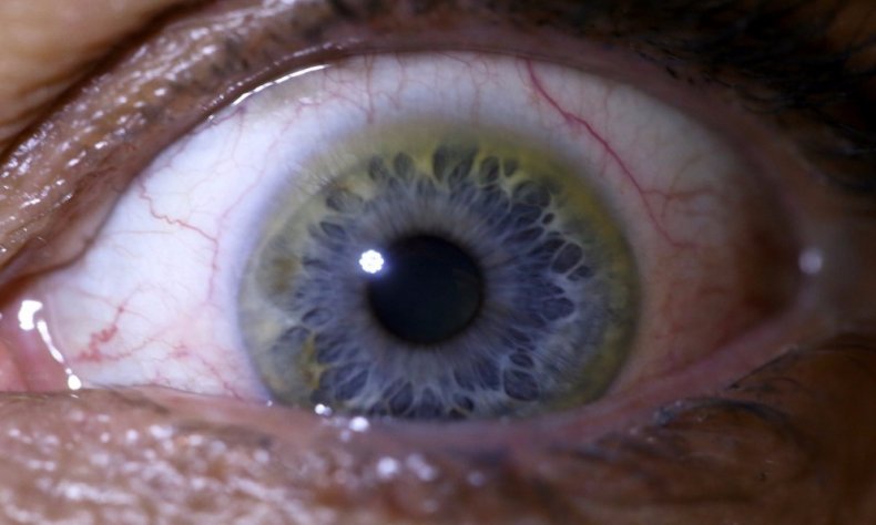 Schimbarea culorii ochilor când se otrăvește cu sulfat de cupru